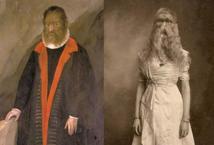 Hypertrichosis voorbeeld