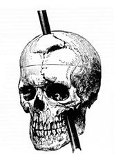 Phineas Gage Phineas Gage