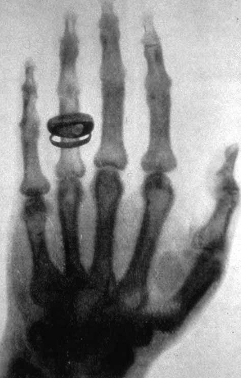 X ray Wilhelm Röntgen Röntgenfoto