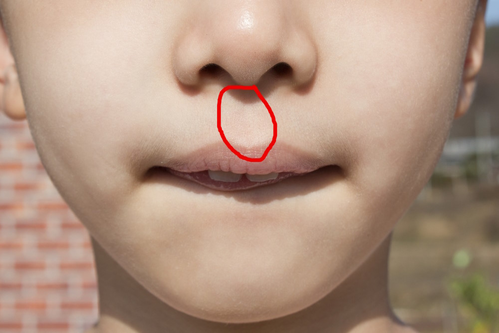 Philtrum Philtrum