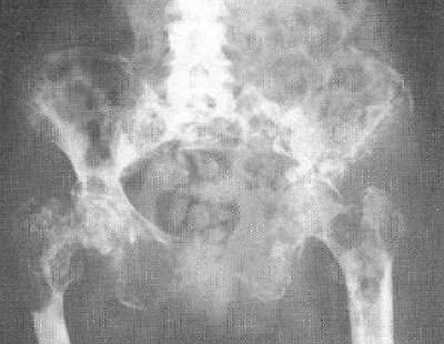 Gorham's disease