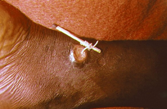Guineaworm